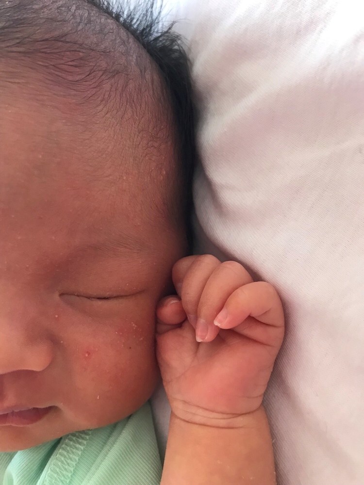 出生20天，脸上一层一层的这种小痘痘顶着白头，头上脸上都是，今天耳朵里也有，有没有遇到