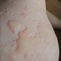 得了荨麻疹怎么办，超级无敌个痒，去医院检查就开了涂的药，没效果。脸都肿了，啊啊啊啊。姐妹们有...