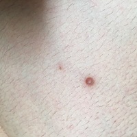 从怀孕开始胸部上面了一颗类似痘痘的东西，在慢慢变大，是什么情况呢？有知道的宝妈吗？