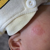 有人知道这个是什么吗，要涂点什么好