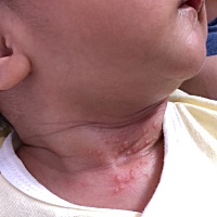 宝妈们，这个是不是长的痱子啊，还是湿疹呀？有什么好东西推荐使用的吗？？