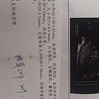 无胎心胎芽，医生让流产 第一张是4月29日照的，医生说当时35天，第二张是60天照的，没有胎心胎芽，医生...