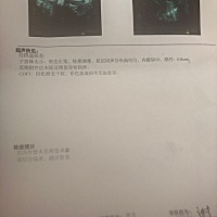 5.24号做了阴超，什么都看不到，也没有孕囊，月底再去看看，会随时发动态，大家一起交流下，