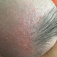 宝宝头上红红的是啥，有懂的宝妈吗，涂什么能好呢