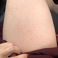 宝妈们可知道我这是什么啊，一出门起这么大的痘，昨天开始痒的，但是没这么大