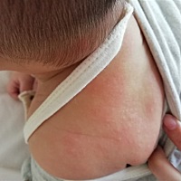 这是湿疹还是痱子啊😞😞😞