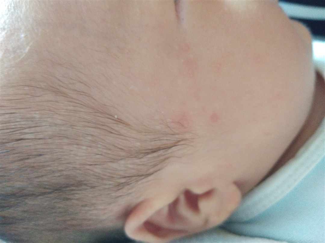 有宝妈知道这是什么么 一个一个小疙瘩 有红色有白色的  上边有白尖