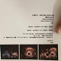 46天，医生说有头和小身体了，目前看着正常。说实话，本身我想做流产的，有一点不忍心，再考虑考虑。因...