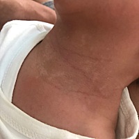 求助，宝宝脖子有一块块白斑，请问有人知道是什么吗