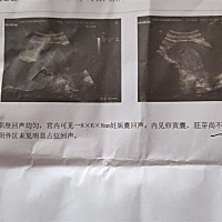 孕囊尺寸能看男女不？哪位会看啊！