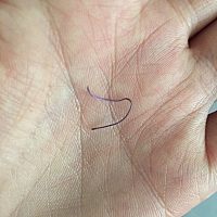 亲谁懂这是能吸收的线，还是要拆的那种？我月子今天21天了，七八天的时候这个线掉了，不过还有一个...