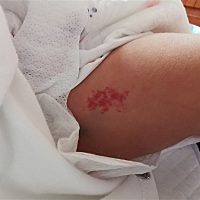 有没有宝宝有出现这个，现在已经慢慢变淡了。