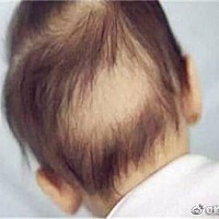 婴幼儿头发稀疏是怎么回事？ 在宝宝出生时，头发的多少因人而异（那时可能多是胎毛和毫毛）。胎儿在子宫...