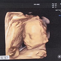 23周四维彩超照片