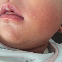 有宝妈知道宝宝脸上这个像脂肪粒的东西是什么吗？出生的时候就有了…