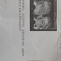 通过这个B超可以看出男宝还是女宝吗？