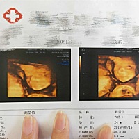 今天24周 一天跑了四趟 宝宝呀  你可为难死老母亲了 终于过关了  能不能看出来像粑粑还是麻麻腻
