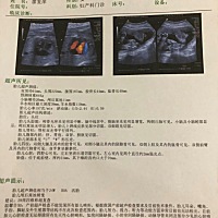 24周做的小四维 检查出颅后窝池11毫米 超出正常范围一毫米  医生建议我去市里面的医院做29周的大四维。...