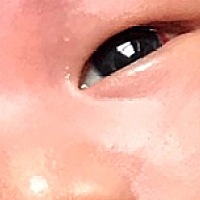 宝宝13天了，出生当天左眼珠就有红色的小块，医生说是顺产挤压的，这么久了还没消失有点担心，有懂的宝...