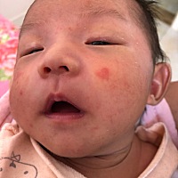 宝宝起湿疹了，看着忒心疼，想问问各位宝妈，用什么药效果好啊？？？