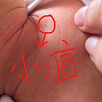 小前两天这里温度才24度，但是满满脖子里和腿恰恰里长了这样的小痘痘，有经验的宝妈帮我看看看是怎么回...