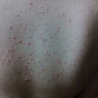 谁能告诉我背上长这么多痘痘怎么办？ 去医院也看不好 好绝望 又痒又痛 越起越多 都蔓延到胸部上了 呜呜...