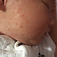 有宝妈知道这是湿疹还是热疹嘛？