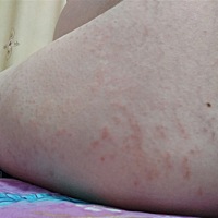痒死了，不知道是不是妊娠湿疹，越长越多，有什么办法吗，孕妈们