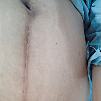 剖腹第17天，刀口长的挺好的