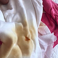 宝宝出生14天，小便有橘黄色斑块，是什么原因？和吃茵栀黄口服液有关吗？大家帮忙看下