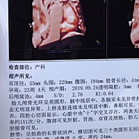 今天做了四维，医生说都挺好的，但就是胎儿是横位，说的是没事宝宝小，自己在肚子里慢慢改变，可心里还...