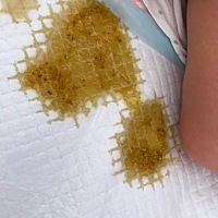 宝宝出生第6天，今天拉的臭臭这是正常吗？吃的母乳