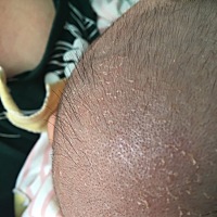 宝宝头上一小块白的那些都是什么呢