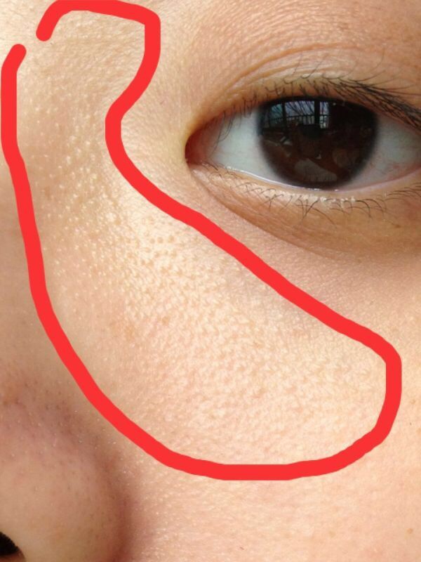 这种情况应该怎么办呢？这是我在网上找的照片，我自己的脸拍照就看不见了了，没这么明显