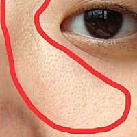 我这个是不是闭口，怎么才能战胜它 这种情况应该怎么办呢？这是我在网上找的照片，我自己的脸拍照就看不...