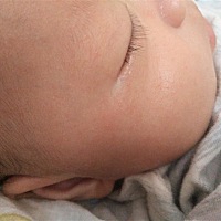 各位宝妈们，请问眼角那块是湿疹吗