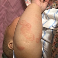 亲们，帮我看一下宝宝手上这长得是什么东西啊，一直都不好，一热就很红，然后遇到热水也会变红。