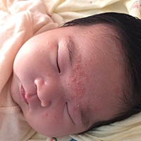 宝宝这个是湿疹吗 在两眼中间也不敢擦药 怕宝宝弄到眼睛里去 怎么办啊。。。