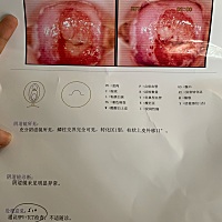 大家帮我看一下，医生说宫颈糜烂二度，说很严重，还有点阴道炎，说治疗不好的话要做手术，叫我定期检查...