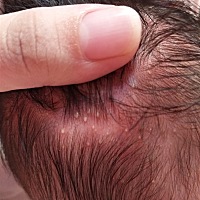 求助，我家宝宝头皮上长好多这样的，是因为什么，太热了吗，还是