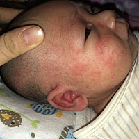 宝宝这脸红的有点恐怖。 脸上一堆粒粒的。是因为热气.还是过敏或者热呢。 有经验的宝妈快告诉我该怎样吧