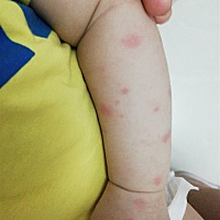 七个月宝宝发烧三天身上起疙瘩，有没有宝妈知道这是什么情况