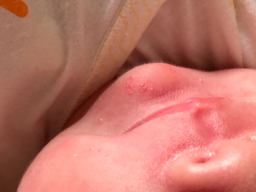 请问下巴是湿疹还是什么？