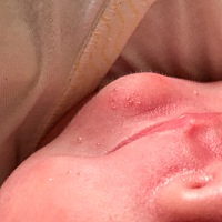 请问下巴是湿疹还是什么？