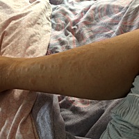 求助！！！产后第七天，第五天时候从医院回家就开始长这个，刚开始一点点到现在满身都是，各位宝妈有知...