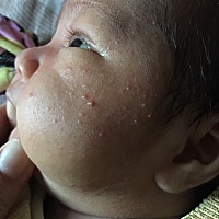 宝宝脸上长了好几个痘痘一样，里面好像有脓一样的一颗颗的东西，宝妈们有什么办法吗？看着好心疼！好几天了