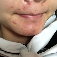 有从怀孕开始脸上就一直在起痘的吗 我每天都要烦死了 碰到都好疼的那种大痘痘 我也不吃辣也不便秘 每天...