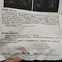 卵圆孔什么意思？