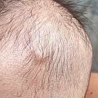 头上有个小包，是什么东东？宝妈们你们宝宝有吗