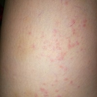 寻帮助，各位宝妈有没有生完宝宝之后得湿疹的？因为我是生了孩子之后得了湿疹，看了三四次医生吃药打针...